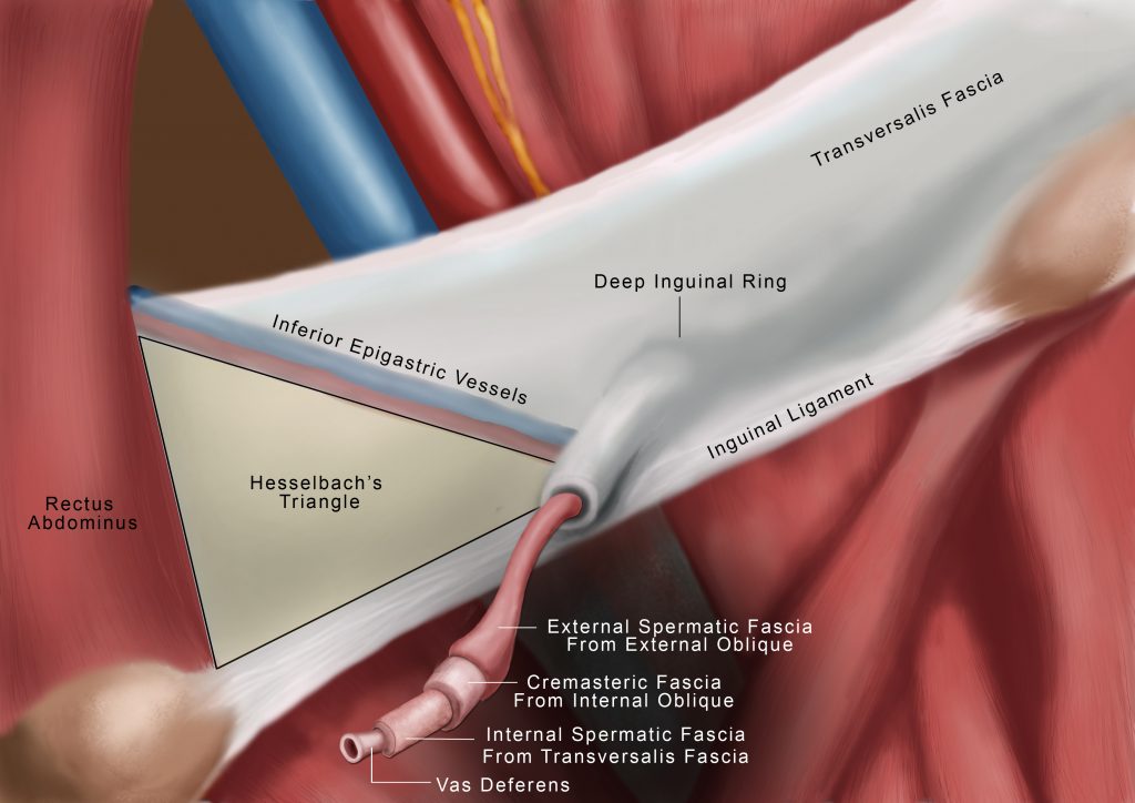Hernia anatomy - extra triangle with spermatic cord Medical Illustration